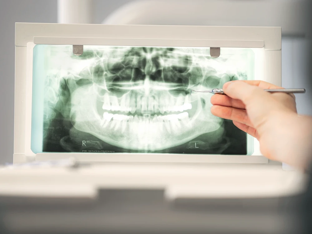 Zahnlockerungen? Ein Fall für uns als Parodontitis&shy;experten.